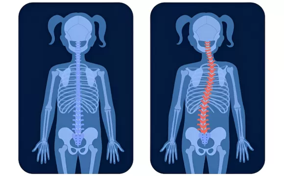 Understanding Scoliosis: What You Need to Know